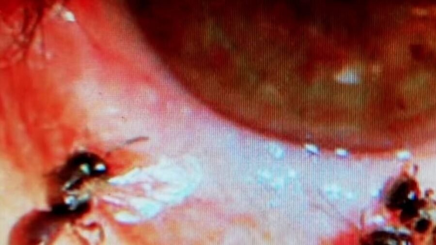 Oftalmologia-Insectos-Enfermedades_raras-Salud_391971553_120744617_1024x576-1